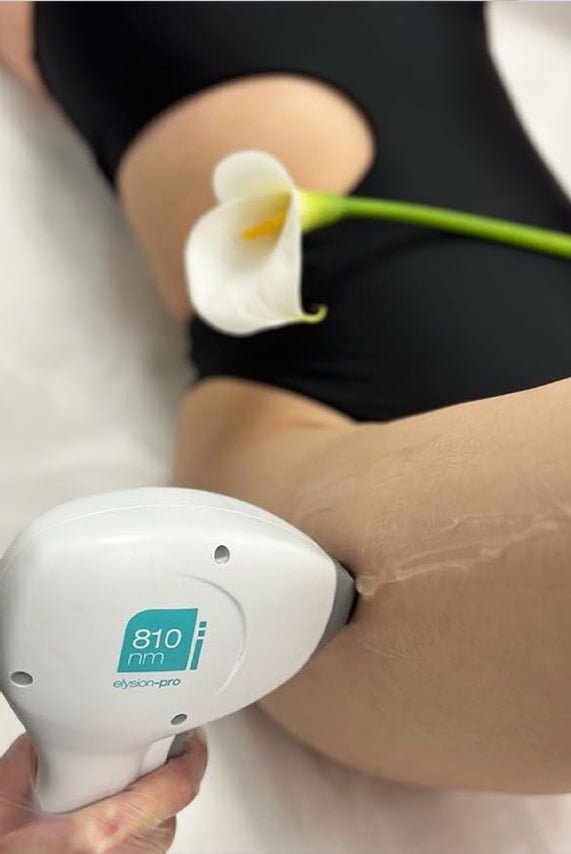 Какво е лазерна епилация